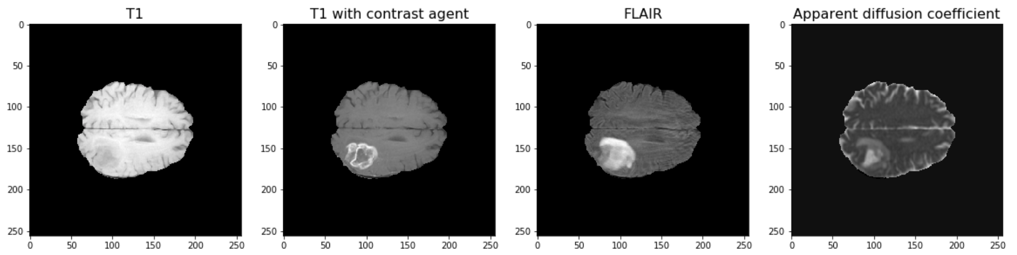 Figure 1: Example image, different MRI modalities imaging glioblastoma